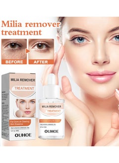 Milia Removal Treatment, Milia Spot Treatment Helps Dissolve And Reduce Milia, Whitehead And Sebaceous Hyperplasia, Cysts And Sebaceous Hyperplasia Face Serum 30 ML - pzsku/Z7B3467EE0BA65F752739Z/45/_/1705981626/507c7730-23c8-4f09-bc92-33096bbe27dd