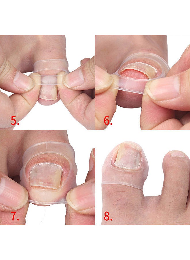 Generic - 2PCS Ingrown Toenail Correction Tool Toe Cap Toenail Protector Big Toe Sleeves Thick Paronychia Correction Tool - Image 1