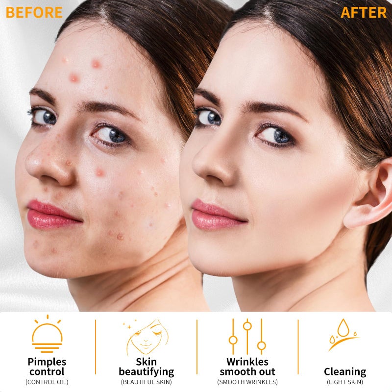 MYSWEETY High F Rrequncy Portable Handheld Facial Skin Care Wand Machine - Image 4