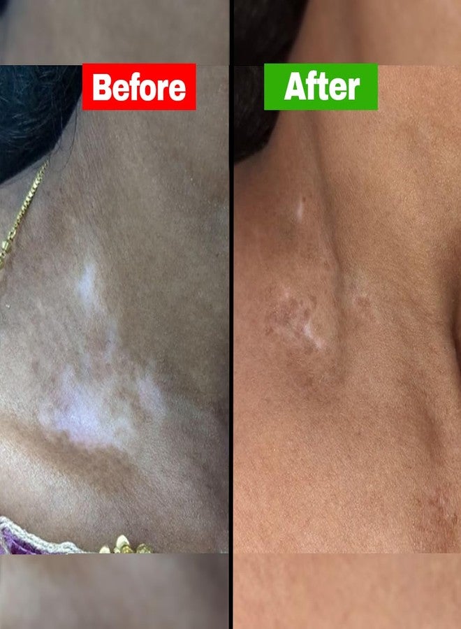 SiyaAyurveda زيت سيا أيورفيدا للصدفية - علاج الصدفية لفروة الرأس الحساسة والمصابة بالحكة والإكزيما | تركيبة مضادة لقشرة الرأس والتهاب الجلد لشعر صحي | زيت جوز الهند للشعر من د. ميغا تشاتورفيدي لعلاج الصدفية - 100 مل - Image 5