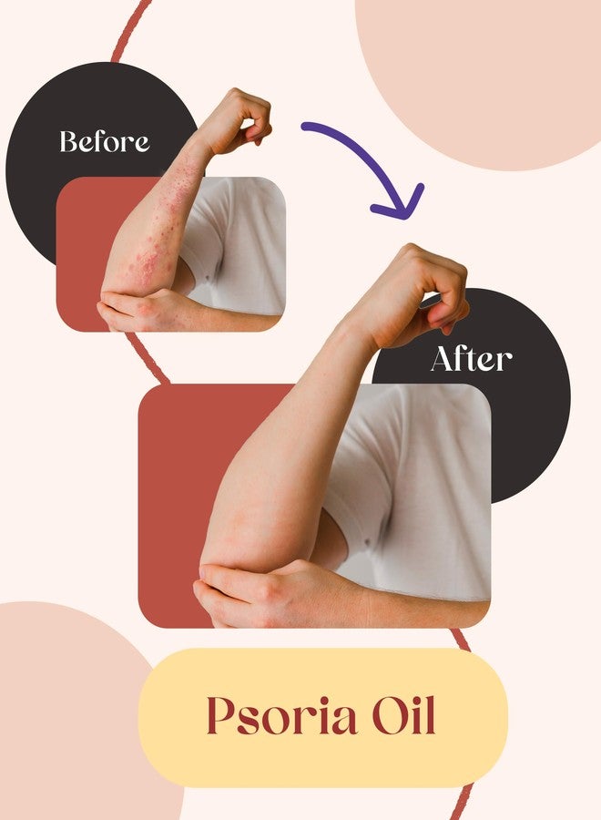 SiyaAyurveda زيت سيا أيورفيدا للصدفية - علاج الصدفية لفروة الرأس الحساسة والمصابة بالحكة والإكزيما | تركيبة مضادة لقشرة الرأس والتهاب الجلد لشعر صحي | زيت جوز الهند للشعر من د. ميغا تشاتورفيدي لعلاج الصدفية - 100 مل - Image 3