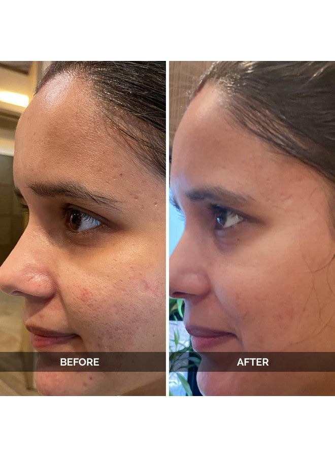 LuxaDerme Pore Perfecting Face Serum - Minimizes Pores, Controls Oil & Sebum, Firms Skin | 96% Natural Ingredients With Lotus Water, Alpaflor® Alp-Sebum, Syn®-Coll, Galactomyces | Korean Skincare - 30Ml  - Image 5