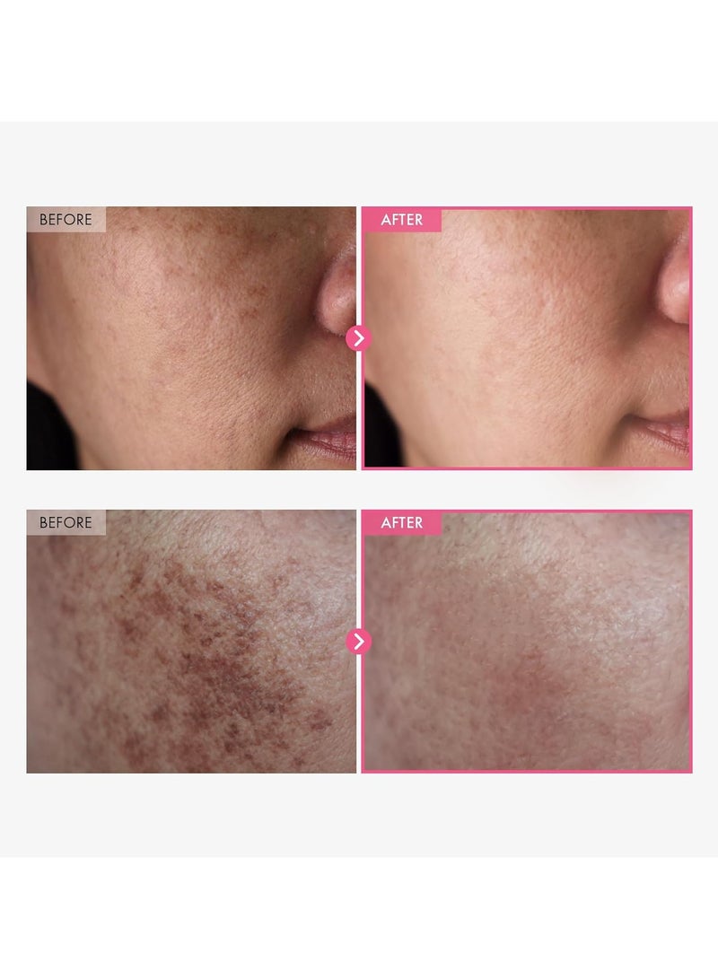 توسوونج أربوتين 7 ٪ + حمض ترانيكساميك 4 ٪ كريم ، أربوتين 70،000 جزء في المليون ، 40،000 جزء في المليون TXA ، نياسيناميد ، غلوتاتيون ، بقع داكنة ، بلع ، بقع ، صبغة ، العناية بالبشرة الكورية ، 50 مل ، 1.69 أوقية فلورية. - Image 2