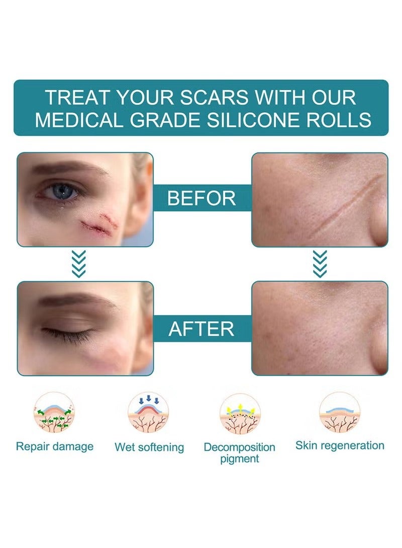 BUPY Silicone Scar Sheets,Effective Safe Breathable Comfortable Long-Lasting Results Scar Care Adopt Advanced Technology to Improve Heal and Lighten Scars for Old and New Scars 4cm*1.5m - Image 2