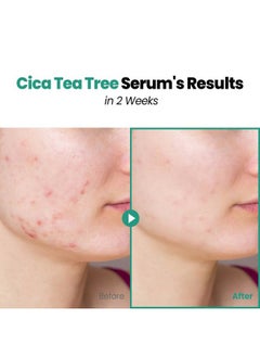 Glam Up CICA Tea Tree serum Double Shot 30ml(1.12 Fl Oz) With HYALURON+BHA Calming Booster Acne Treatment Tea Tree Oil & Niacinmid for Acne Blackhead Treatment, Sensitive Skin Care  - Image 3