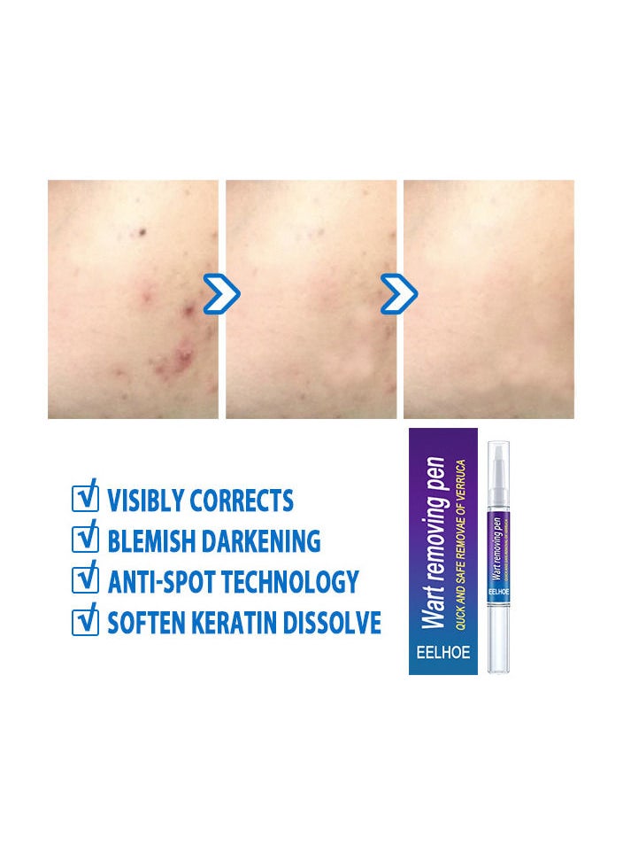 EELHOE - Wart Removing Pen - Image 1