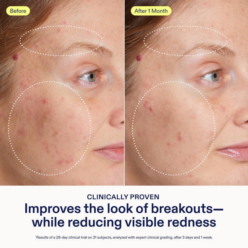 Skinfix Adapinoid Gel - 1 oz - Retinoid Serum for Acne-Prone Skin with Niacinamide - Visibly Reduces Redness & Improves Look of Breakouts and Pores - Fragrance Free - Vegan, Cruelty Free - Image 4