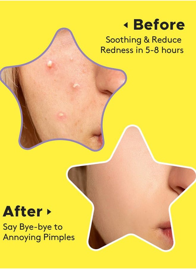 Acne Patch Pimple Patch, Colorful Star Hydrocolloid Acne Patches For Face, Cute Zit Patch Acne Sticker Spot Pimple Patches for Face, Tea Tree Oil + Centella (112 Count)