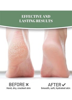 Generic Urea Cream 120g, Foot and Hand Creams for Dry and Cracked Hands and Heels, Guaranteed Relief for Extremely Dry, Cracked, Rough, Dead and Dry Skin Instantly Boosts Moisture Levels for Feet and Hands  - Image 5