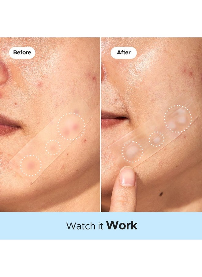 LitBear LitBear Large Pimple Patches for Face (4 Sizes 80 Patches), Big Acne Patches, XL Hydrocolloid Bandages Strips for Body, Forehead, Cheek, Chin, Butt, Back & Chest, Rectangle hydrocolloid Patch  - Image 4