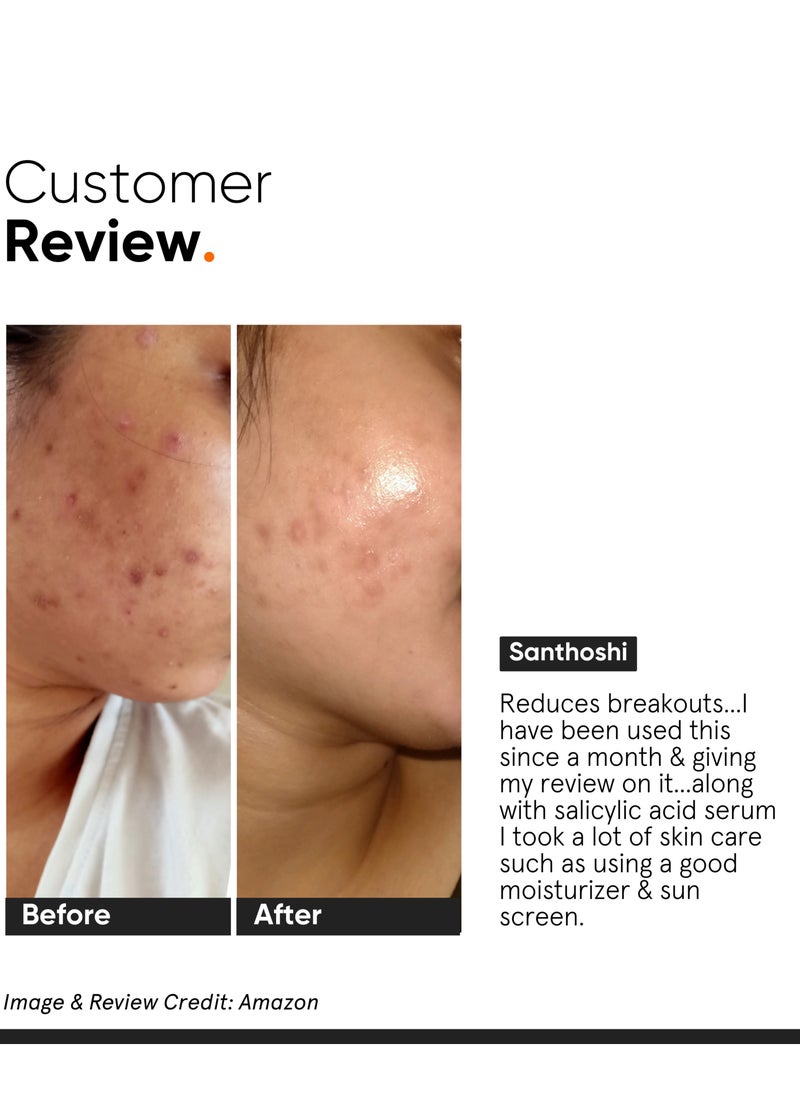 2% Salicylic Acid Serum For Reducing Oily Skin, Acne And Blackheads | Helps With Open Pores, Breakouts And Bumpy Texture
