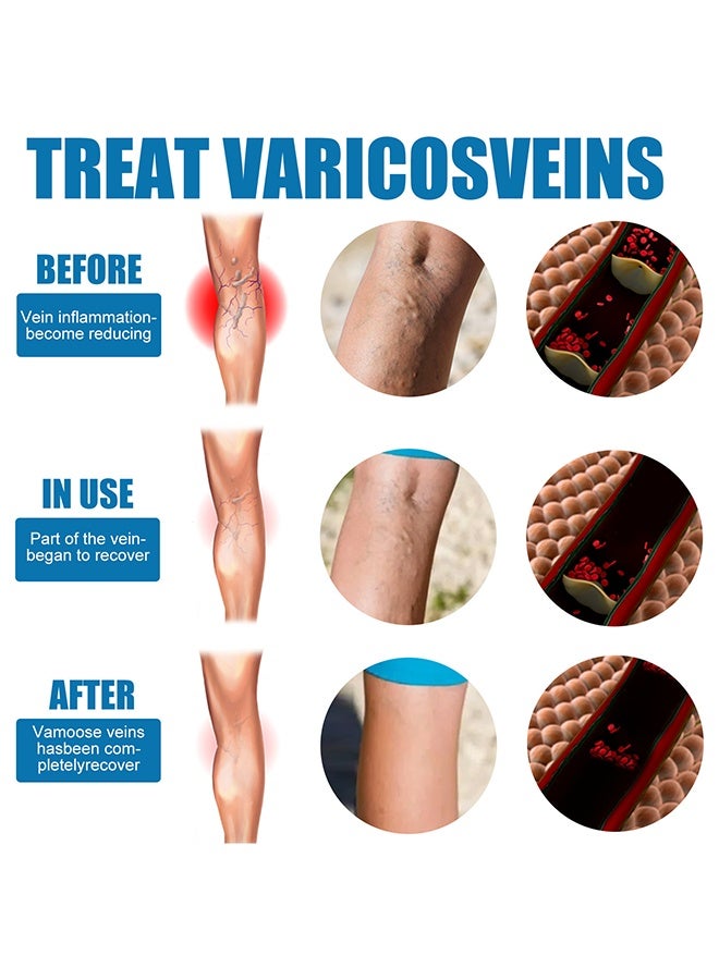 ساوث مون بخاخ تسكين الأوردة 30 مل، بخاخ علاج عضلة قدم الأوردة، يخفف من تعب الساق - Image 2