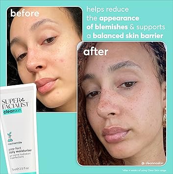 Super Facialist Breakout Buster Serum Clear Skin Solutions Spot Treatment for Acne with 10 Niacinamide Tea Tree Oil Prebiotics Vegan Friendly 30ml - Image 3