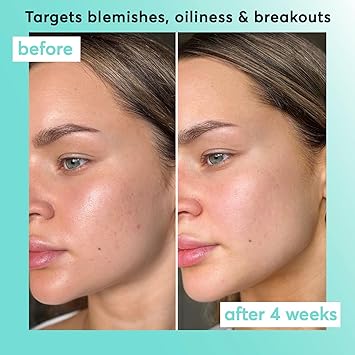 Super Facialist Breakout Buster Serum Clear Skin Solutions Spot Treatment for Acne with 10 Niacinamide Tea Tree Oil Prebiotics Vegan Friendly 30ml - Image 5