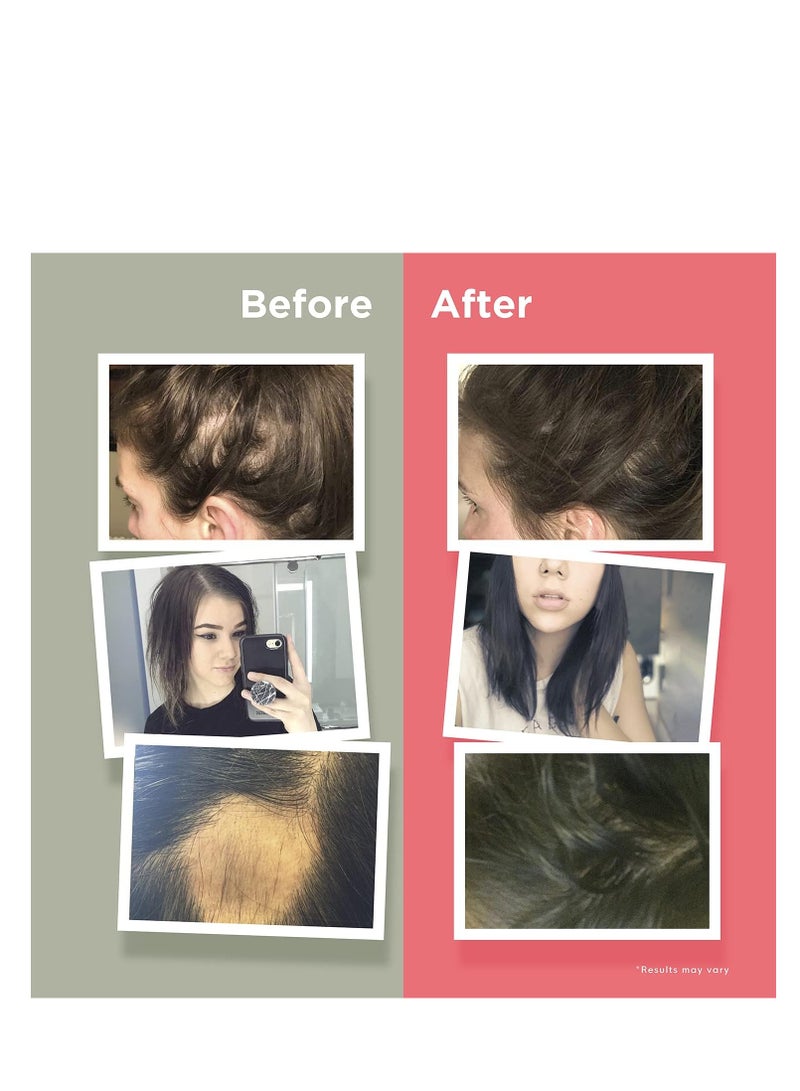HairAnew Hair Growth Vitamins for Women & Men - Hair Vitamins For Faster Hair Growth & Thickness - Part of Proceeds go to Hair Loss Charity - Vegan Hair Supplement For Hair Skin Nails (1)