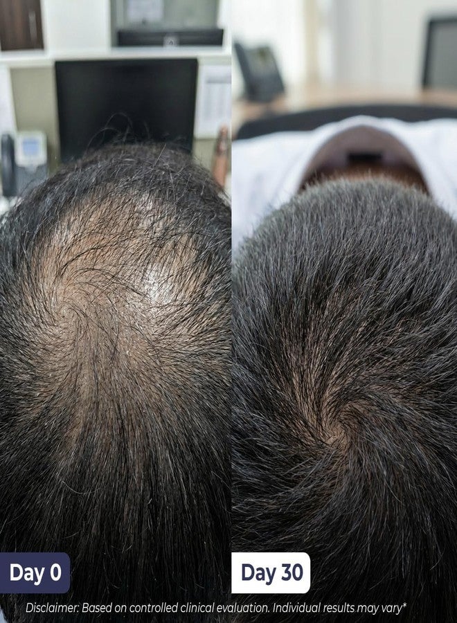 كيميائي واعي سيروم كونشيس كيميست® لنمو الشعر ومنع تساقطه | إكليل الجبل، ريدينسيل، أناجين، بروكابيل، بيوتين، ومنشار بالميتو | يتحكم في تساقط الشعر ويعزز نموه | يحسن كثافة الشعر | للرجال والنساء | 30 مل - Image 3