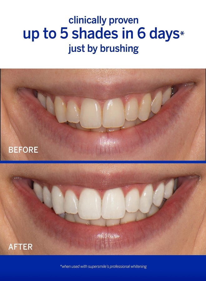 Supersmile Awake & Relax Teeth Whitening Kit - Image 3