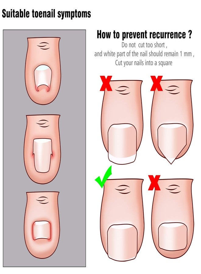 مادر مجموعة أدوات العناية بالأظافر الغائرة، تتضمن رافعة الأظافر الغائرة، مشبك تصحيح الأظافر، و4 لصقات تصحيح الأظافر الغائرة. - Image 3