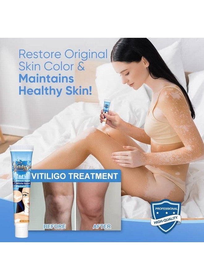 Xshows - Vitiligo Cream Vitiligo Treatment For Reduce White Spots And Improve Skin Pigmentation - Image 1
