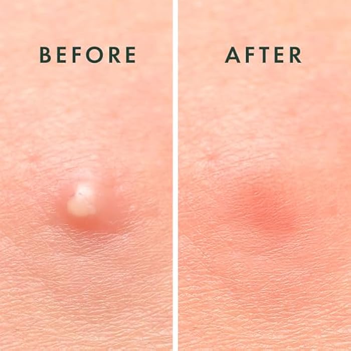 Rael Pimple Patches, Miracle Invisible Spot Cover - Hydrocolloid Acne Pimple Patch, Absorbs Zits & Blemish, Korean Skin Care, 2 Sizes (96 Count) - Image 5