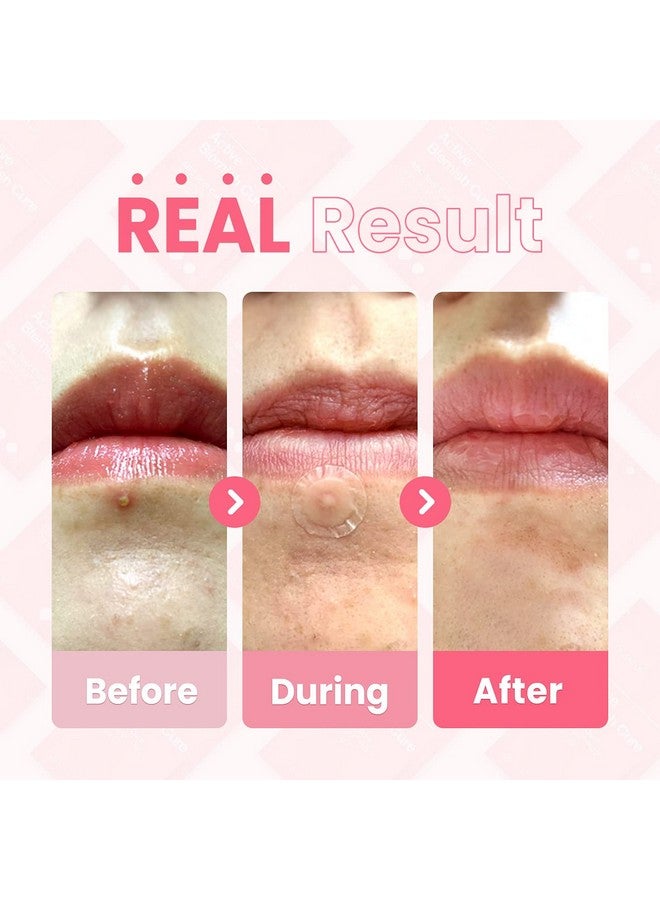 Glam Up Hydrocolloid Blemish Pimple Zit Patches(180Pcs/2Size) Invisible Ultra Thin Spot Cover Stickers For Face And Skin Strong Waterproof And Adhesive Overnight Veganfriendly - Image 5