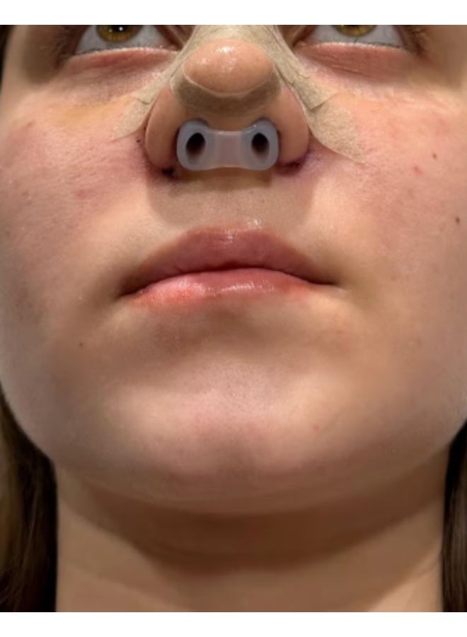 Sanitary silicone nose stabilizer for the face and original microporous adhesive, surgical nose pad, nose stabilizer for rhinoplasty, surgical stabilizer, 100% silicone nose stud - Image 5