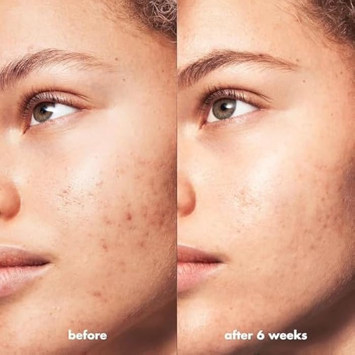 elf e.l.f. SKIN Blemish Breakthrough Clarifying Cleanser, Gel Cleanser For Removing Makeup, Controlling Oil & Clarifying Pores, 1% Salicylic Acid - Image 5