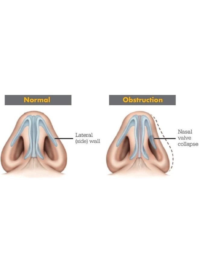 URGAID - Urgaid Breathmax Nasal Strip for Better Breathing, Better Sleeping, Reduced Snoring - 10 Strips - Image 1