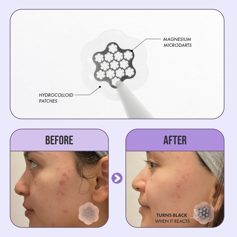 Free Go Magnesium Blemish Microdarts | Pimple Patch | Cystic Acne | Fast-Acting | Quick Calming | 99.9% Pure Magnesium | Madecassic Acid | Tea Tree | Eucalyptus Leaf | Hydrocolloid Spot Care - Image 3