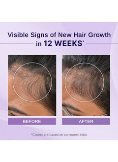 BARE ANATOMY Nature X Science Rosemary Hibiscus Hair Growth Oil For Women & Men | Promotes New Hair Growth & Strengthens Hair | Nourishes Scalp & Controls Hair Fall | Suitable For All Hair Types-100Ml  - Image 2