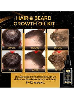 beaueli Minoxidil for Men Beard Growth Kit, Minoxidil for Women Hair Growth Kit, Hair Loss Treatments for Women Hair Regrowth Treatment, Minoxidil 5%, Black  - Image 2