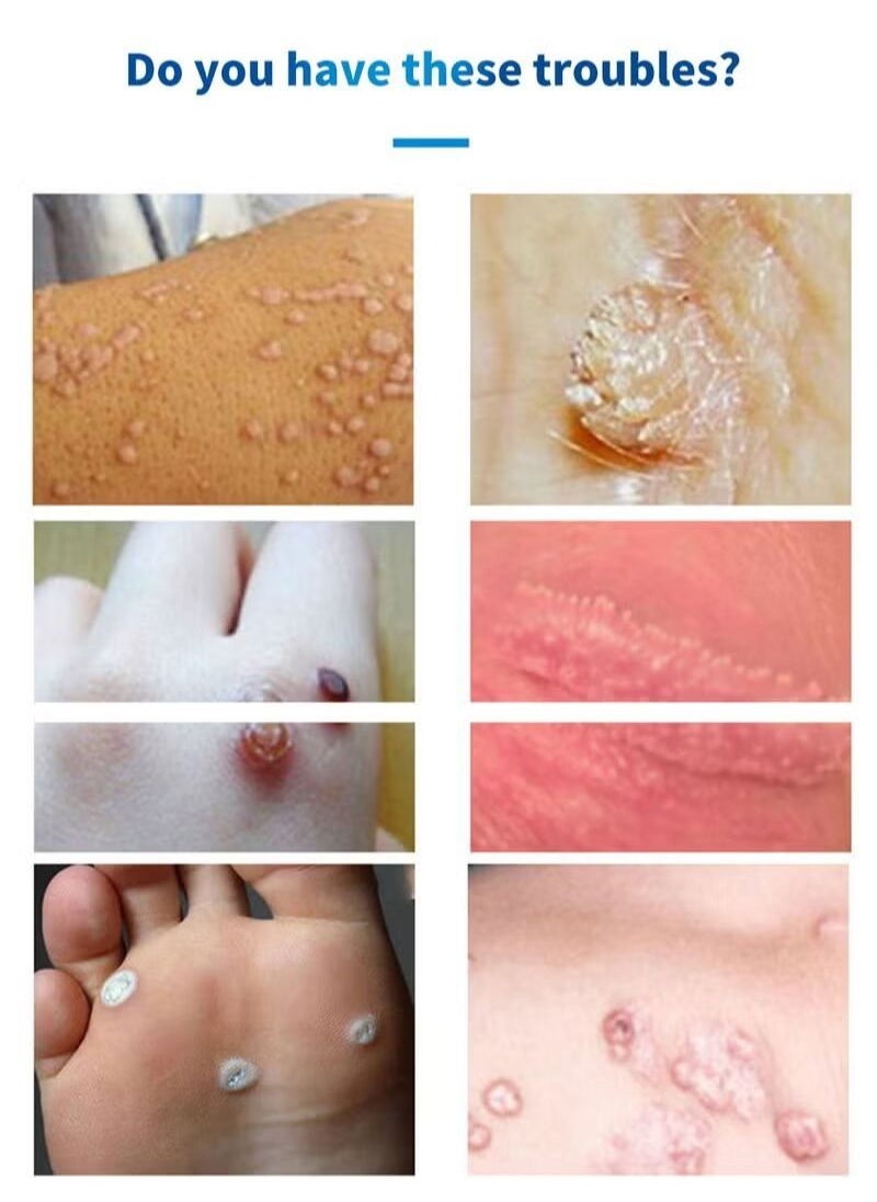 HEALMUSZ - Wart Remover Safe and Effective Natural Herbal Formula High Absorption Fast Acting Stop Wart Regrowth Non Irritating Wart Remover for All Kinds of Skins Type 10ml - Image 1