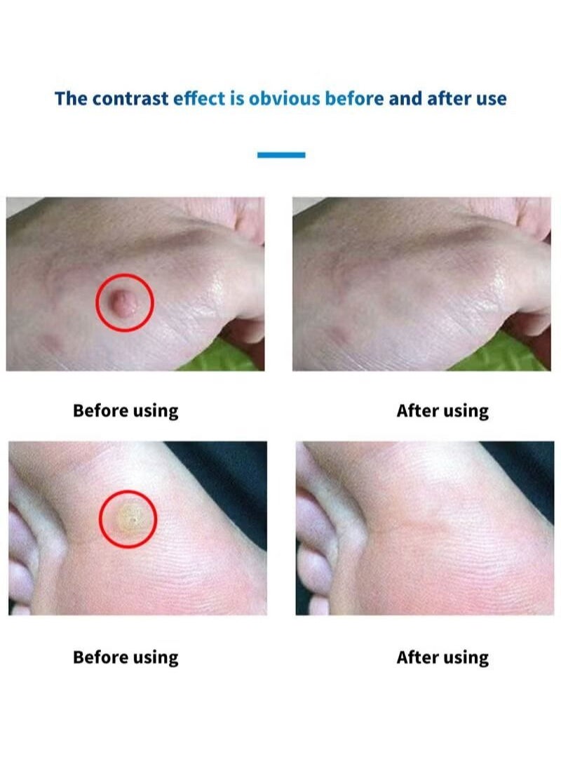 HEALMUSZ - Wart Remover Safe and Effective Natural Herbal Formula High Absorption Fast Acting Stop Wart Regrowth Non Irritating Wart Remover for All Kinds of Skins Type 10ml - Image 1