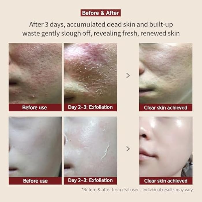 BQCELL [BQCELL] [Made In Korea] [DERMA SKIN PEELING 2g / Recell Cure Serum 2ml, Safety Cap 1ea, 3set], Acne Skin Available, Exfoliating, Facial Scrub, Korean Beauty, Blackhead Remover - Image 3