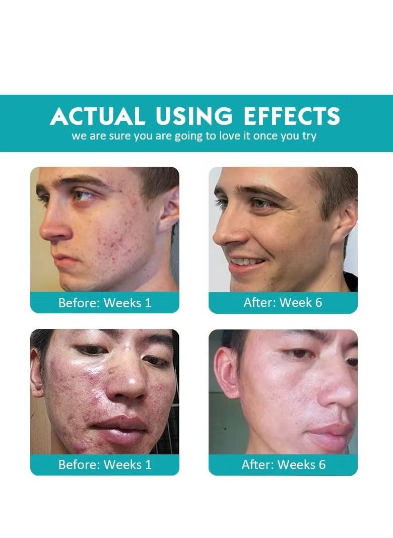 CARVENCHY - 3 Step Acne Treatment 30 Day Complete Acne Skin Care Kit - Image 1