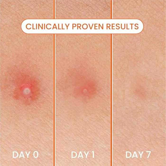 Bioré Biore Pimple Patches, Cover & Conquer Blemish Patch, Medical Grade Ultra-Thin Hydrocolloid for Covering Zits and Blemishes, HSA/FSA Approved, 30 Count - Image 5