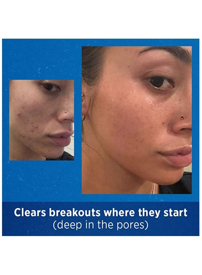 differin Acne Treatment Gel 90 Day Supply Retinoid Treatment for Acne Prone Sensitive Skin 45g - Image 3