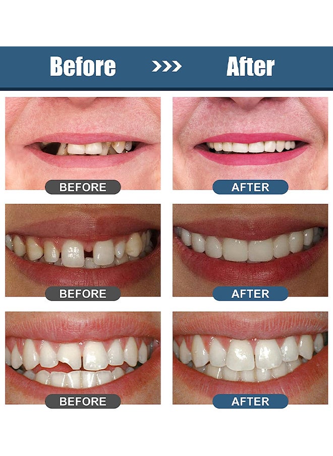 HOMTOPY - Temporary Teeth Replacement Product, Moldable Tooth Replacements, Cavity Filler For Teeth, Temp Tooth Beads With 4 Dental Tools, Repair Missing Or Broken Teeth, Snap On Instant And Confident Smile - Image 1