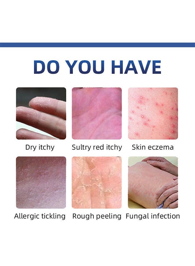 هيلموسز مرهم الصدفية، كريم الصدفية للجلد الجاف، سريع الشفاء من القشدة العشبية، مرهم الصدفية لتخفيف الجلد، كريم إكزيما المضاد للفطريات، المرهم اليومي والمرطب لإكزيما -20G - Image 2