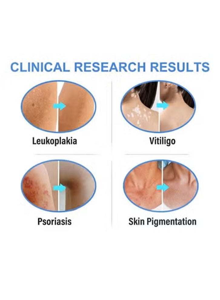 SOL LORA Vitiligo Ointment  Skin Vitiligo Treatment  Vitiligo Care Cream Reduces White Spots and Improves Skin Pigmentation (20g) - Image 3