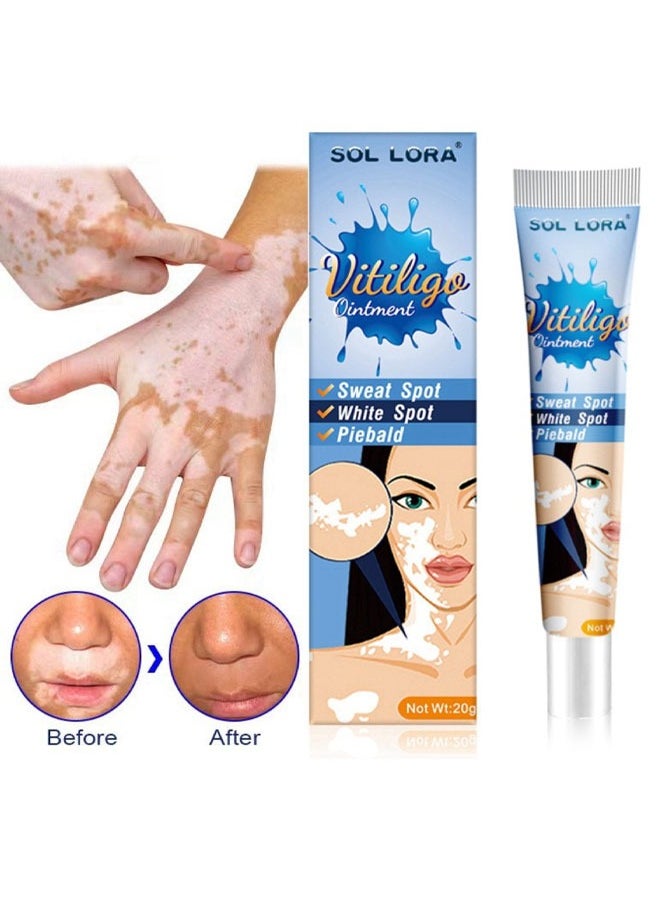 SOL LORA - Vitiligo Ointment  Skin Vitiligo Treatment  Vitiligo Care Cream Reduces White Spots and Improves Skin Pigmentation (20g) - Image 1