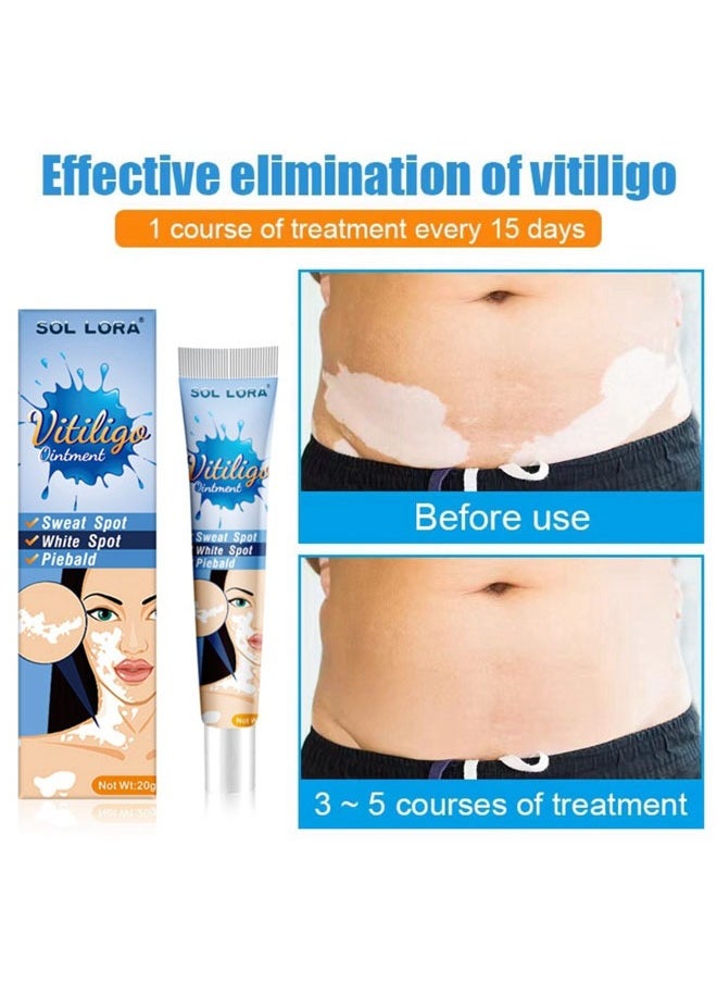 SOL LORA - Vitiligo Ointment  Skin Vitiligo Treatment  Vitiligo Care Cream Reduces White Spots and Improves Skin Pigmentation (20g) - Image 1