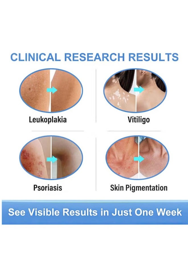 SOL LORA - Vitiligo Ointment  Skin Vitiligo Treatment  Vitiligo Care Cream Reduces White Spots and Improves Skin Pigmentation (20g) - Image 1