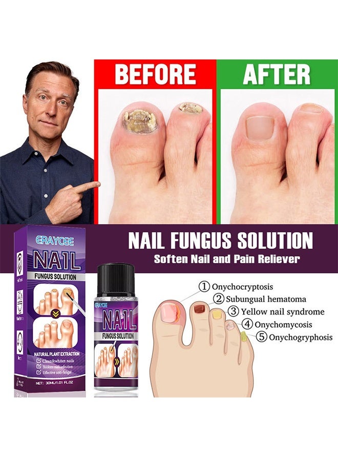ERAYCEE Nail Fungus Solution - Fungal Nail Treatment for Toe Nail and Fingernails-Nail Repair Solution for Thick/Broken/Discolored Nails-Renews Damaged Cracked Ingrown Toenail 30ml - Image 4