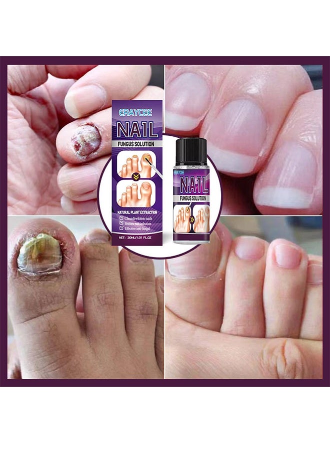 ERAYCEE Nail Fungus Solution - Fungal Nail Treatment for Toe Nail and Fingernails-Nail Repair Solution for Thick/Broken/Discolored Nails-Renews Damaged Cracked Ingrown Toenail 30ml - Image 2