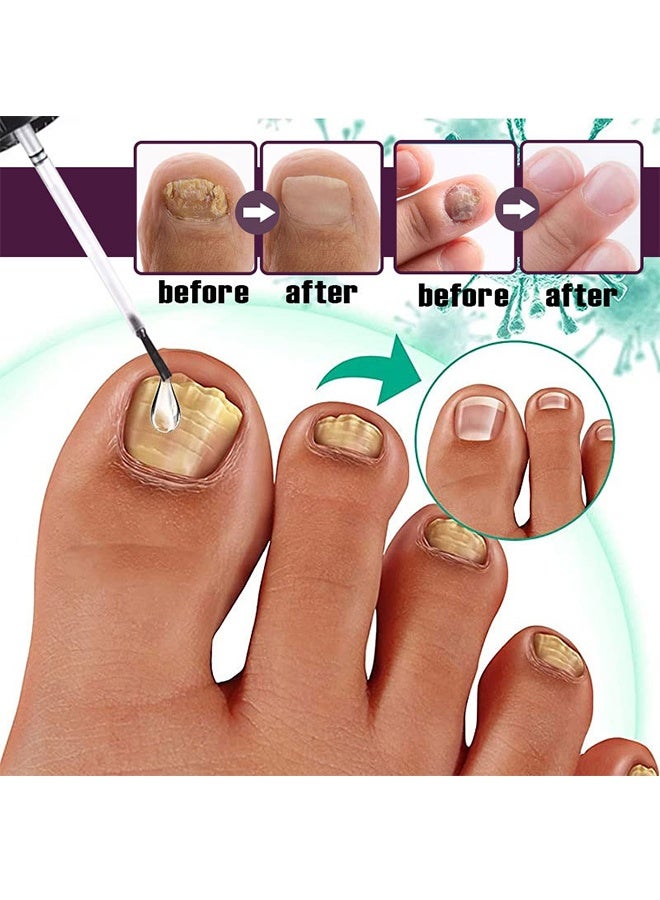 ERAYCEE Nail Fungus Solution - Fungal Nail Treatment for Toe Nail and Fingernails-Nail Repair Solution for Thick/Broken/Discolored Nails-Renews Damaged Cracked Ingrown Toenail 30ml - Image 5