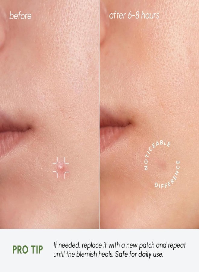 MAREE Invisible Pimple Patches - Clear Pimple Patches for Face - Hydrocolloid Acne Patches Anti Blemish - Zit Stickers for Face - Parches Para Acne - Pinple Zit Patches Pimple Stickers - 72 Dots - Image 5
