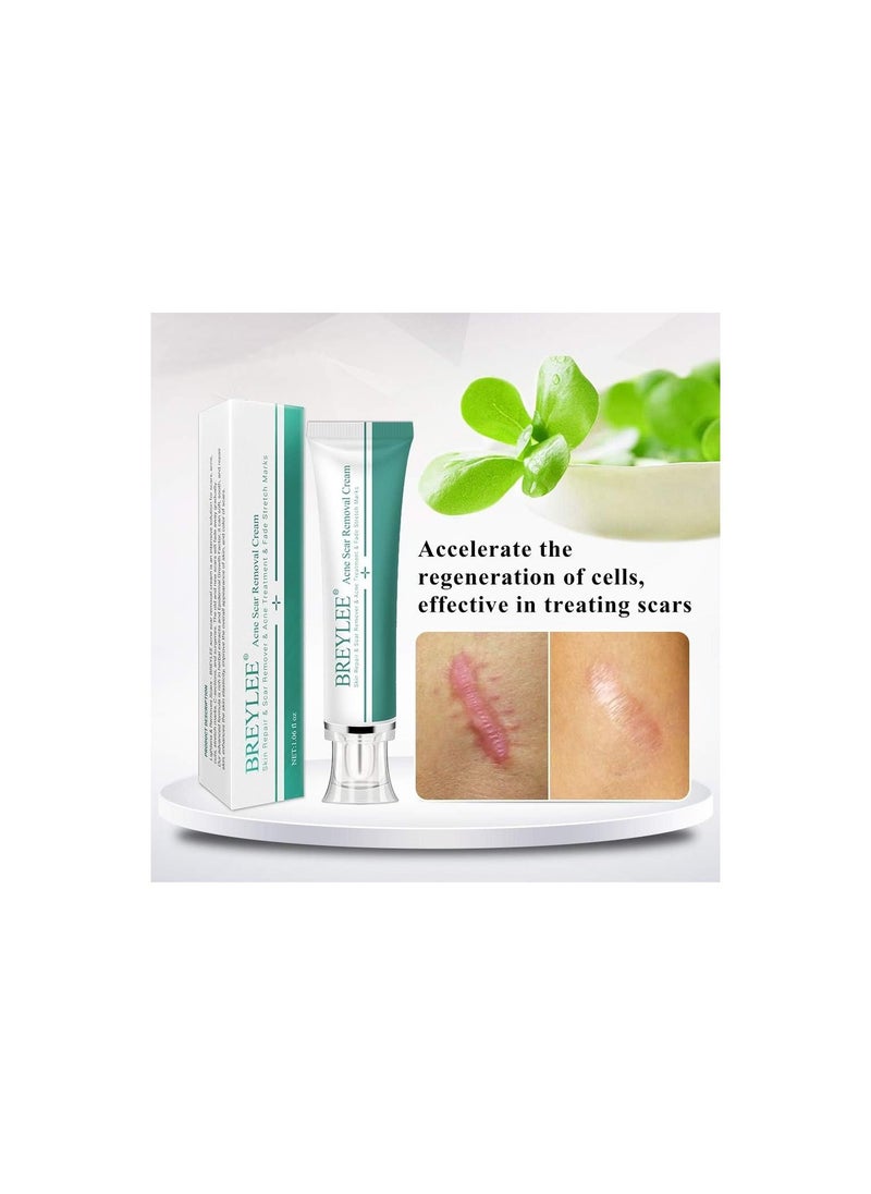 Acne Scar Removal Face Cream Skin Repair Care Remove Stretch Marks Whitening Cream (30g)