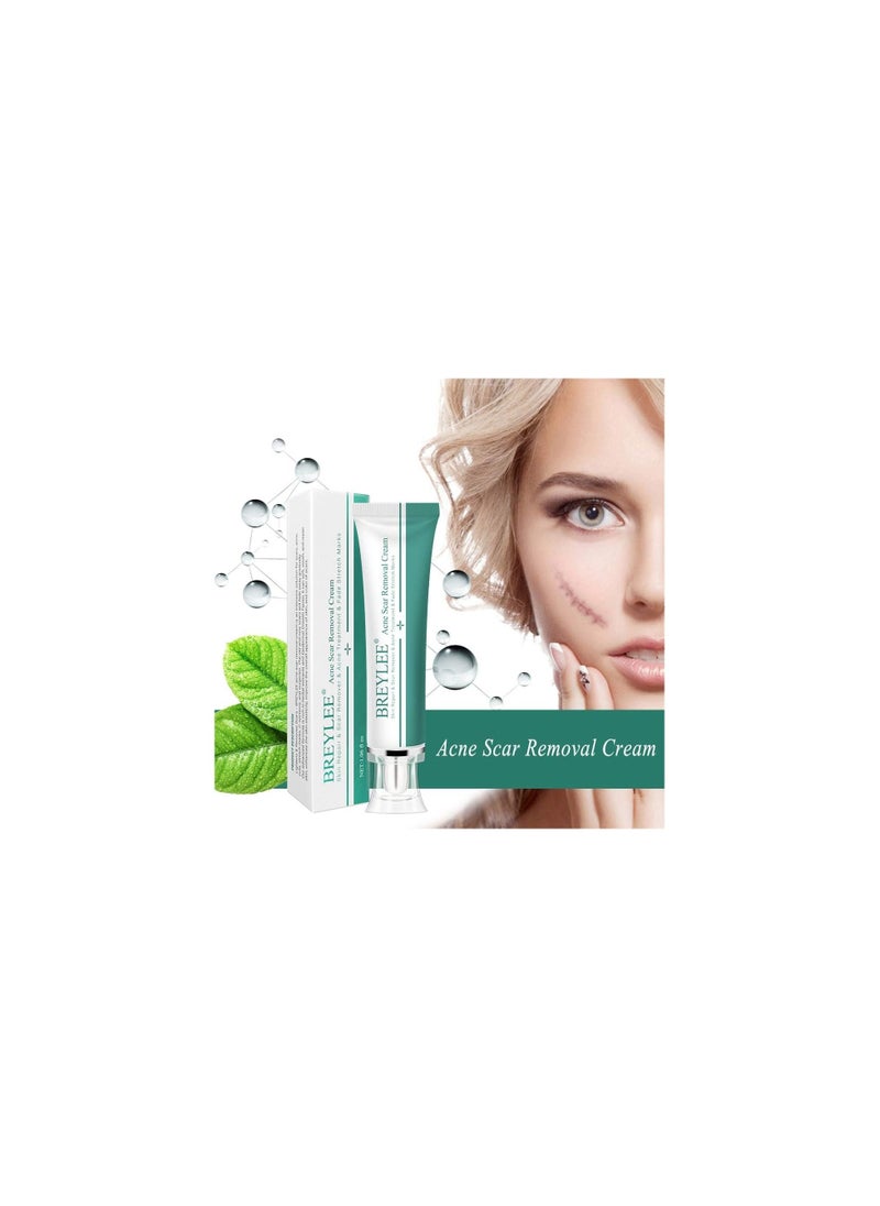 Acne Scar Removal Face Cream Skin Repair Care Remove Stretch Marks Whitening Cream (30g)