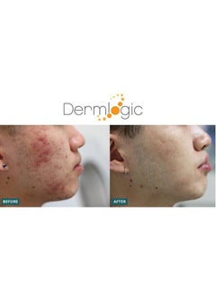 Dermlogic Acne Treatment Padscontains Glycolic Lactic Salicylic Acid. Eliminates Oily Skin Clogged Pores & Cystic Breakouts. Removes Dark Spots Whitehead & Blackhead Pimples For Face & Body.  - Image 5